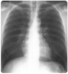 tratamiento contra toda enfermedad respiratoria